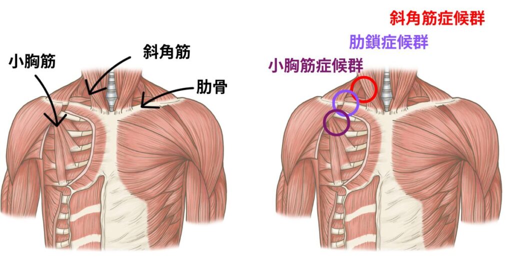 胸郭出口症候群